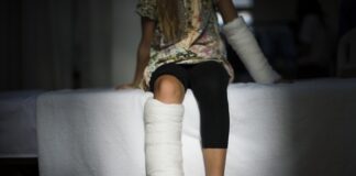 Czy złamana noga zawsze kwalifikuje się do odszkodowania